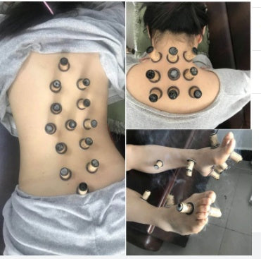 Moxibustion Acupuncture Healing Cupping